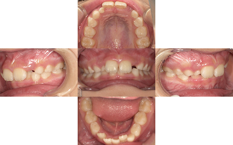 症例6-Before-北名古屋みらい歯科